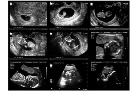 dating scan at 11 weeks